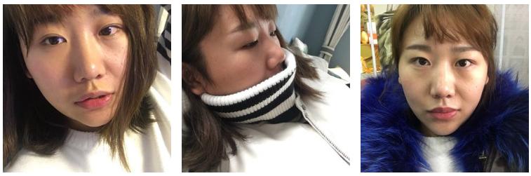 全切双眼皮会不会显老,全切双眼皮显老可以修复年轻吗