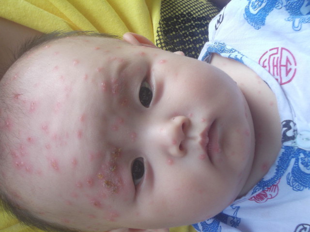 六个月宝宝感染水痘,六个月宝宝出水痘发烧了怎么办