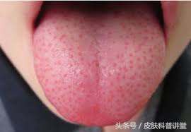 如何辨别儿童猩红热,儿童猩红热的症状与表现