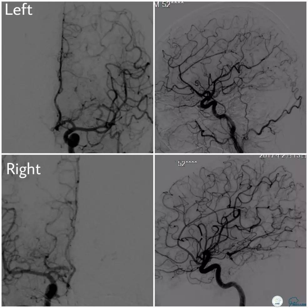 天坛医院基底动脉,天坛医院脑血管支架费用高吗