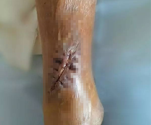 术后刀口露钢板不愈合中医疗法,术后伤口有个小洞一直不愈合