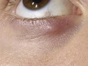 霰粒肿和麦粒肿是一样的吗,麦粒肿和霰粒肿有什么危害