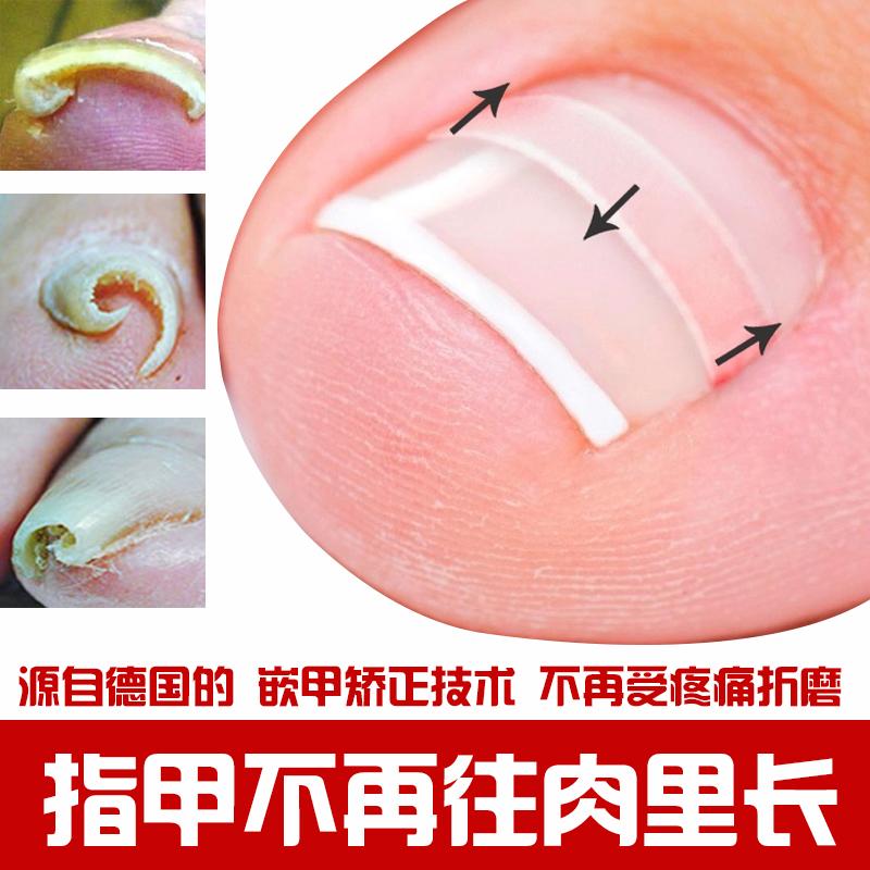 嵌甲型甲沟炎用什么药膏可以治好,治疗嵌甲甲沟炎有效的方法