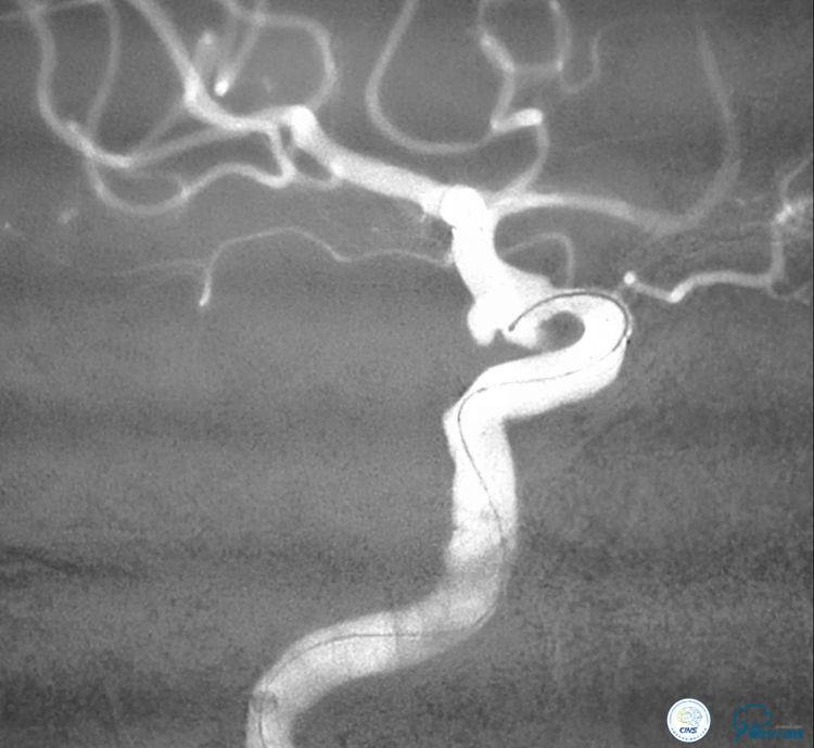支架辅助弹簧圈栓塞治疗狭窄伴复杂动脉瘤