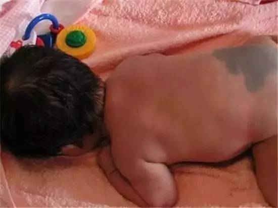 哪些胎记有危险,宝宝胎记是什么原因造成的