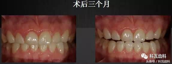 门下门牙有缝隙怎么补救,门牙开缝怎么处理最好