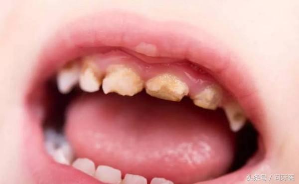 乳牙有黑块需要补吗,宝宝乳牙黄斑怎么治疗