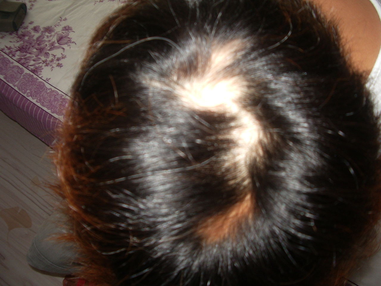 年轻人脱发的原因有什么食疗办法,年轻人脱发有白头发是什么原因