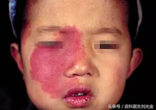 胎记按病因分为几类,胎记的原因及解决方法