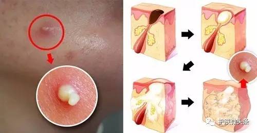 挤痘留下的疤怎么办,鼻翼挤痘留下增生性痘印