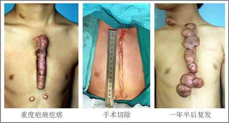 word妈呀!你真的不重视疤痕疙瘩治疗吗?看看这些危害吧