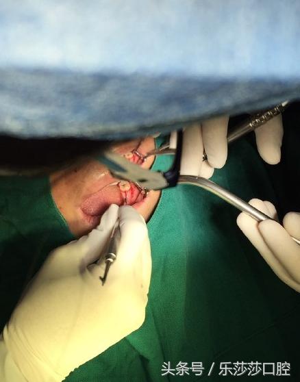 种植牙到底有多痛苦,种植牙真实经历详细全部过程