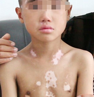 小孩子患上白斑怎么办?饮食也要多注意?