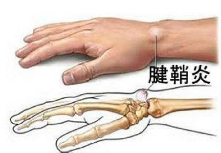 经常抱孩子的家长手腕酸胀可能是患了腱鞘炎，怎么正确抱孩子？