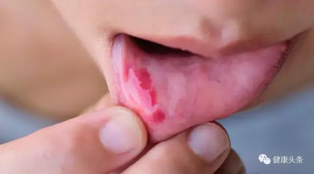 嘴巴溃疡吃什么食物最好,嘴巴里长溃疡可以吃什么