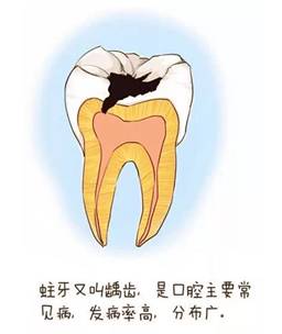 中年人如何防止蛀牙扩散,老年人蛀牙已经烂空了怎么办