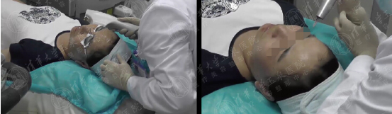 激光祛斑反弹最真实的经历,都说激光祛痘没用是真的吗