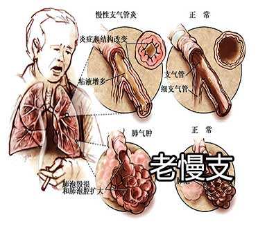 慢性支气管炎的最好偏方,慢性支气管炎小偏方