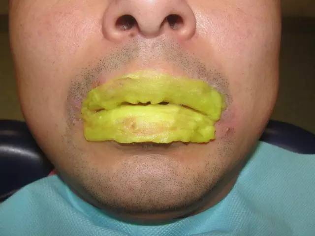 嘴唇上火起皮最快最有效的方法,上火引起的嘴唇干裂起皮怎么治