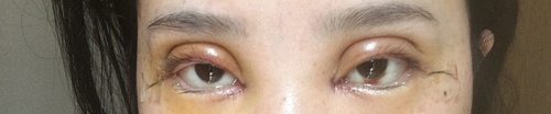 全切双眼皮疤痕增生多久可以恢复,全切双眼皮恢复过程经历真实