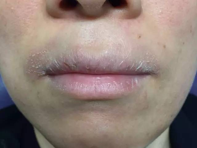 嘴唇上火起皮最快最有效的方法,上火引起的嘴唇干裂起皮怎么治