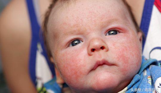 宝宝得了湿疹抹药了可以打疫苗吗,宝宝湿疹不能用激素药膏吗