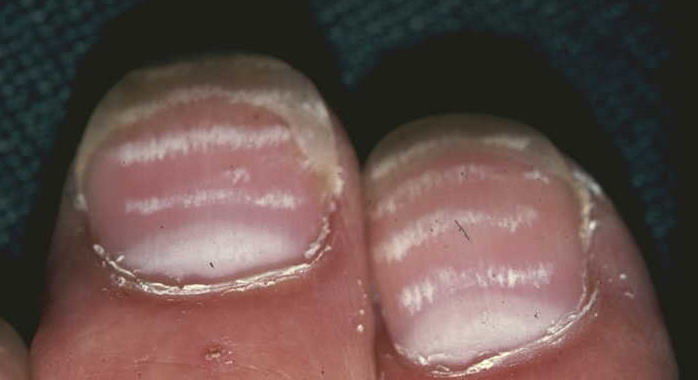 12岁孩子指甲有白斑是怎么回事,指甲上有坑坑洼洼的小点怎么回事