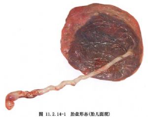 胎盘到底是啥样的,胎盘子宫后壁