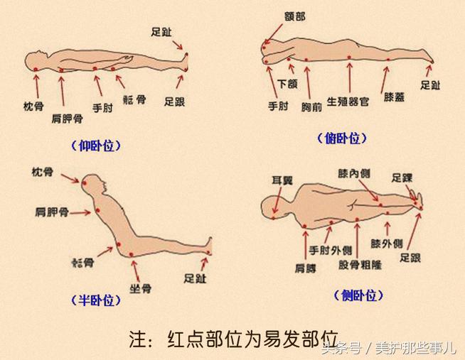 褥疮用碘伏消毒后可以用紫药水吗,老年人的褥疮能用碘酒消毒吗