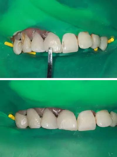 目前补救可乐牙最好的办法,可乐牙的治疗贵么