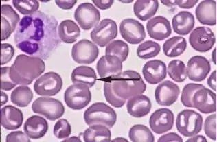 外周血细胞涂片的正常值,外周血细胞分析多长时间出结果