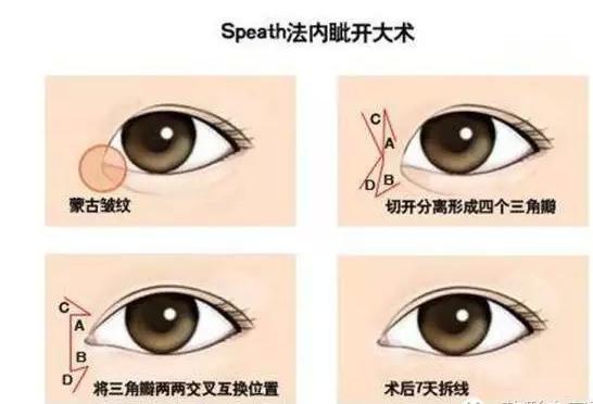 内眼角去哪里开,内眼角怎么开眼角