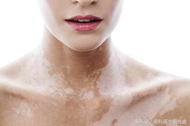 20岁的小姑娘确诊白癜风能治好吗,大师教你三招治白癜风