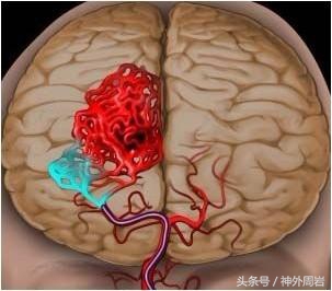 脑出血和脑溢血有何区别,脑出血与脑溢血是什么原因引起的
