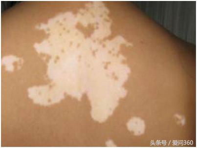 白癜风的原因和治疗方法是什么,白癜风外伤引起的怎么治疗