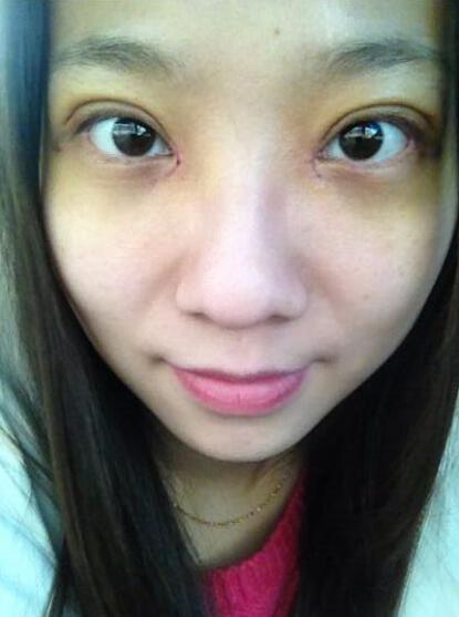 完美的埋线双眼皮,完美双眼皮