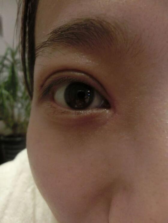 完美的埋线双眼皮,完美双眼皮