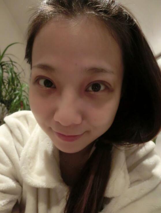 完美的埋线双眼皮,完美双眼皮