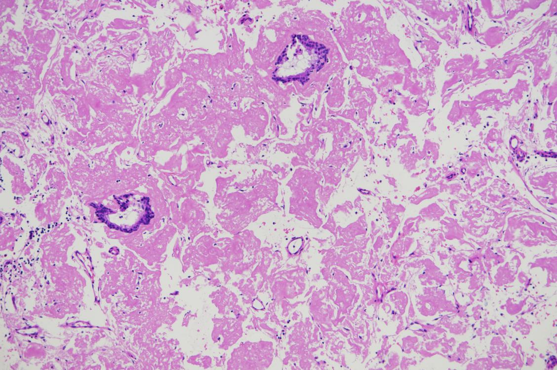 反复咳嗽咳痰气喘5年,长期咳嗽气短久治不愈的原因
