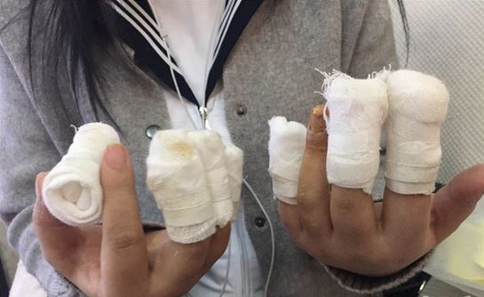 姑娘被拔手指甲,四根手指不敢做美甲