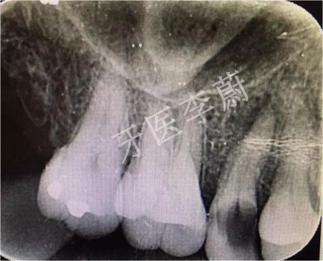 前牙残根桩冠修复,前磨牙嵌体修复