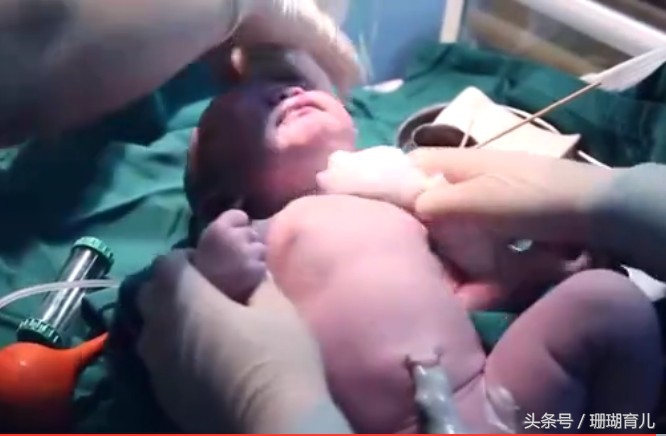 顺产生孩子剖腹产的真实流程,生小孩剖腹产和顺产哪个需要勇气