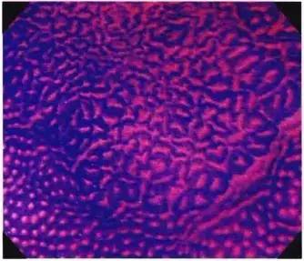 普通内镜与Pitpattern分型（多图详解）