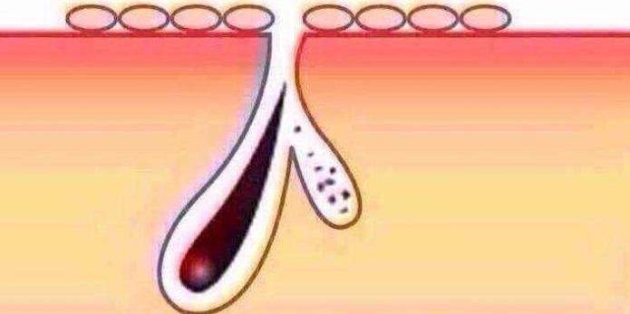 收缩毛孔最好的产品,什么药可以收缩毛孔