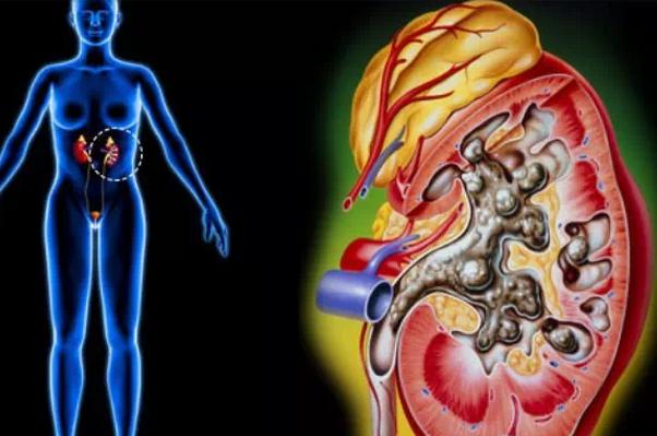 腰疼是因为肾结石着凉后就疼,腰疼和肾结石有关系吗