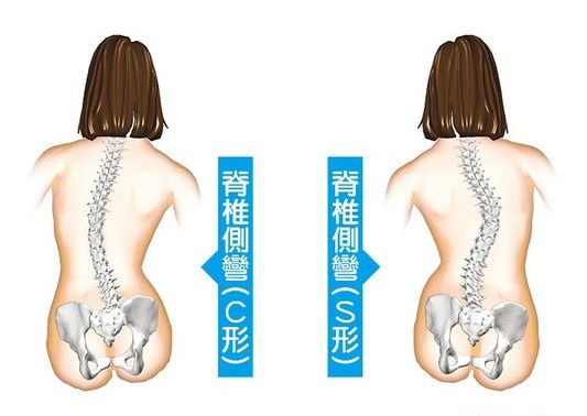 针灸治疗脊柱侧弯的最好方法,脊柱侧弯s型了有办法治疗吗