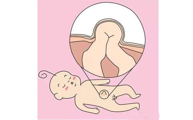 新生儿脐疝如何处理,新生儿脐疝初期怎么处理