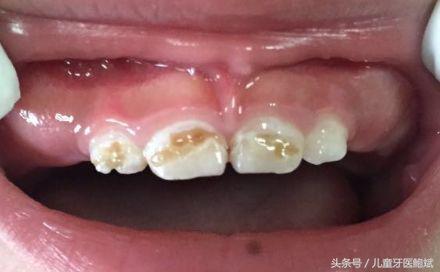 奶瓶龋特别严重怎么办,奶瓶龋齿了怎么办