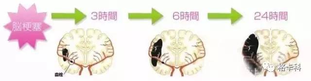 脑血管梗塞治疗方法,脑血管梗塞治疗最佳方法