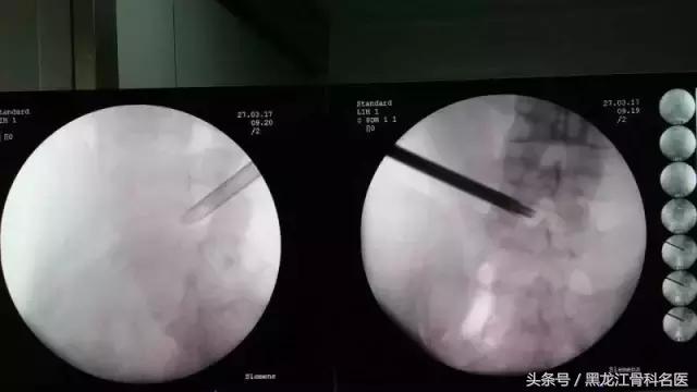 病例分享丨微创疗法让老人远离“腰突”困扰